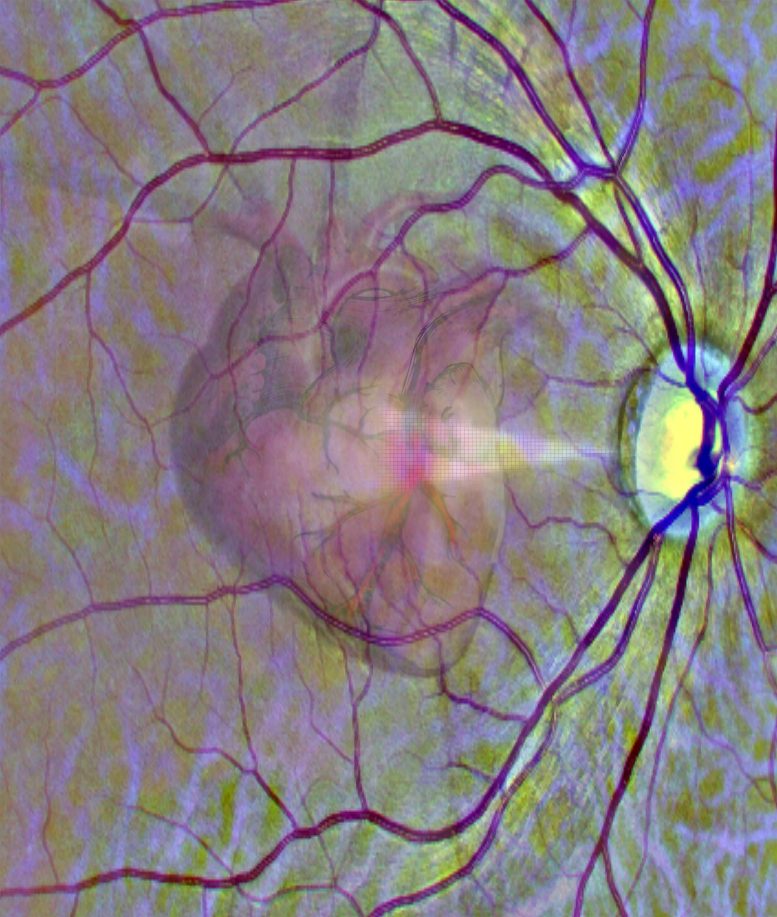 Μπορεί ένα eyescan να προλάβει το έμφραγμα;