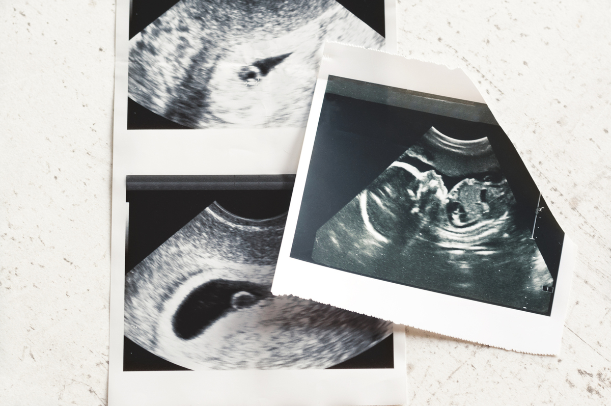 υπερηχογράφημα