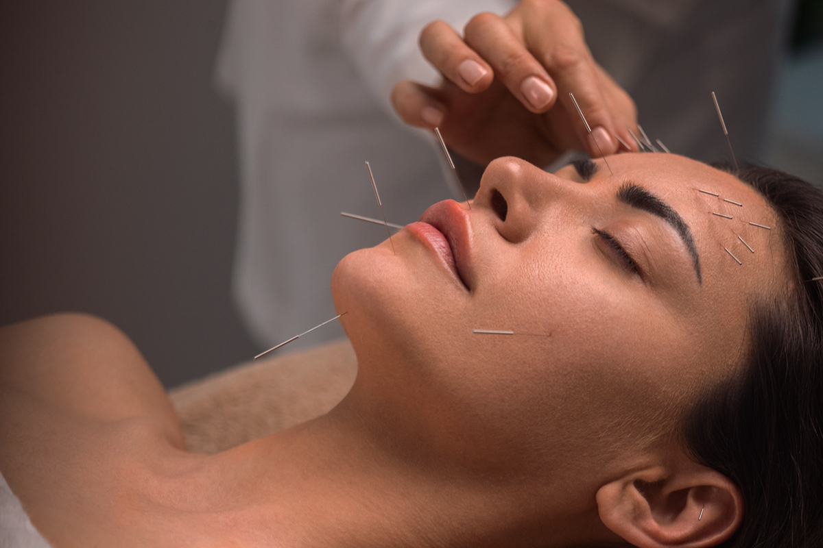 Μπορεί ο βελονισμός να περιορίσει την κεφαλαλγία;