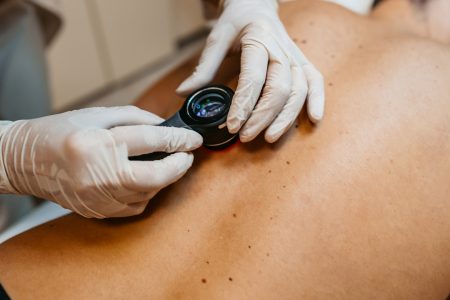 Καρκίνος του δέρματος: Τα σημάδια που δεν πρέπει να αγνοήσεις