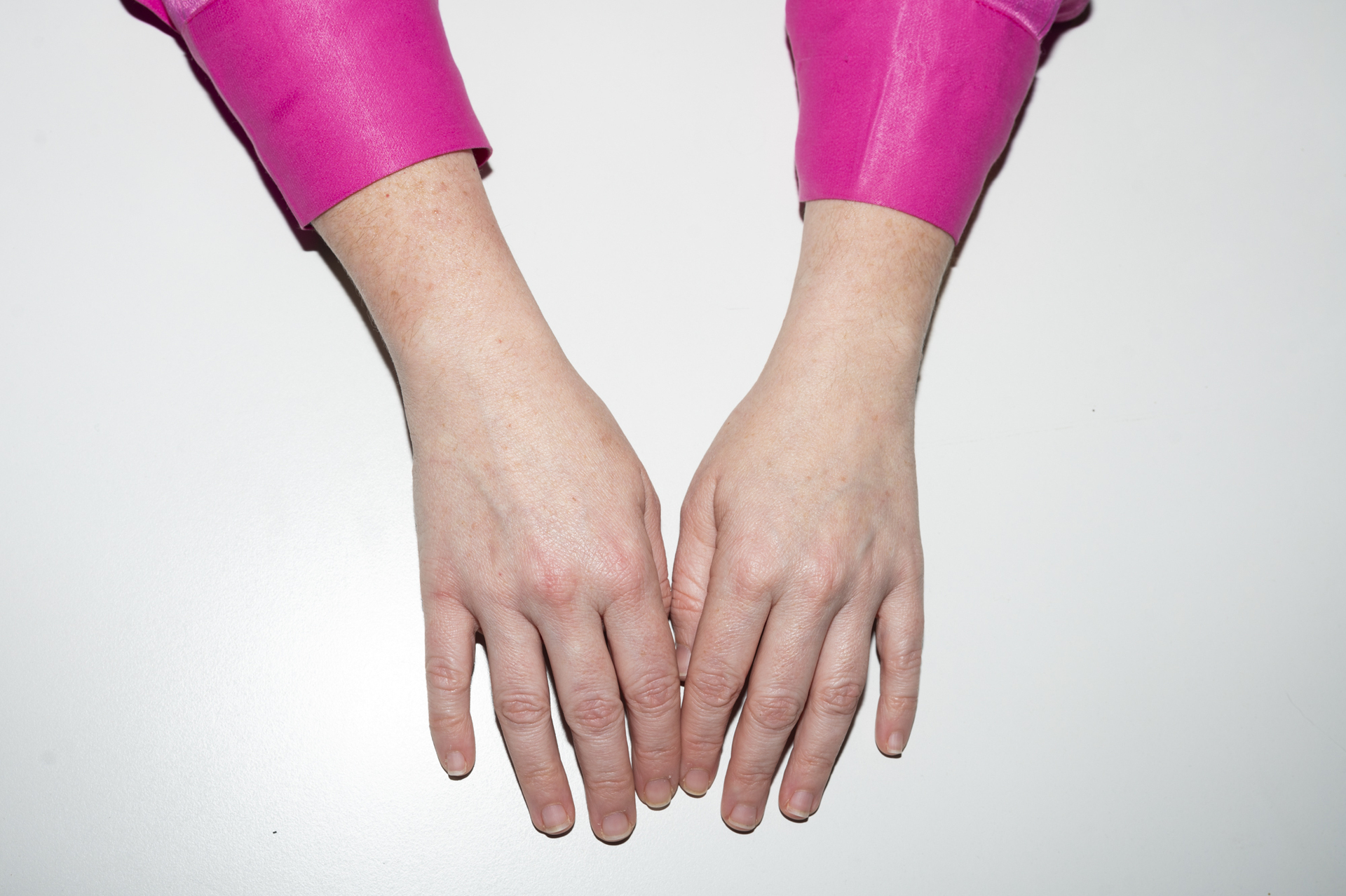 Πώς έσβησα τις κηλίδες από τα χέρια μου