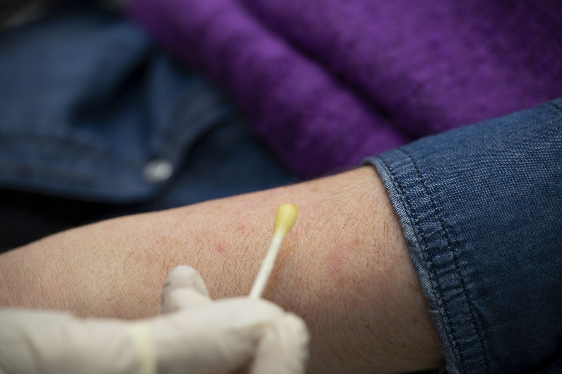 Πώς έσβησα τις κηλίδες από τα χέρια μου