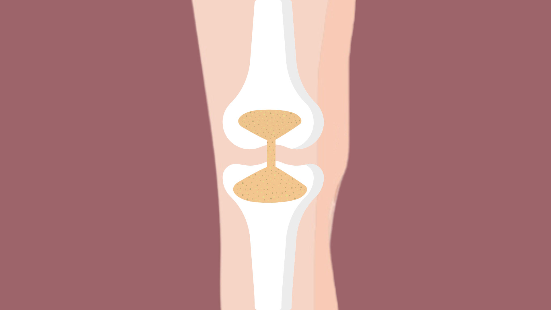 οστεοαρθρίτιδα