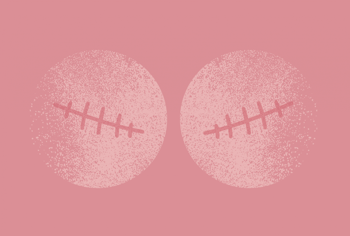 Μαστεκτομή