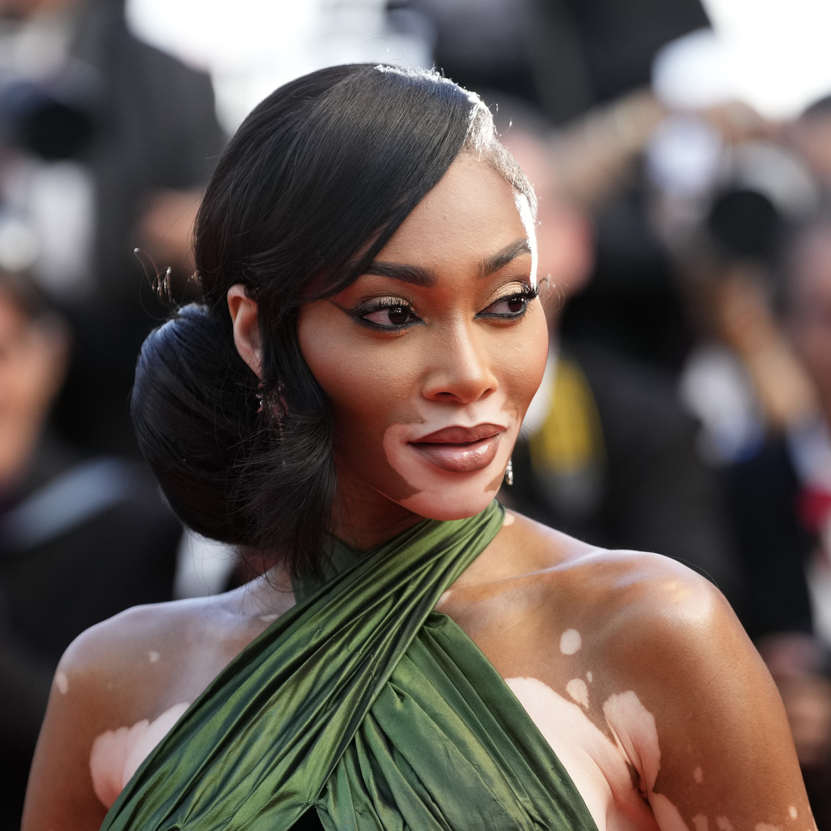 5 celebrities απενεχοποιούν τα δερματικά τους προβλήματα