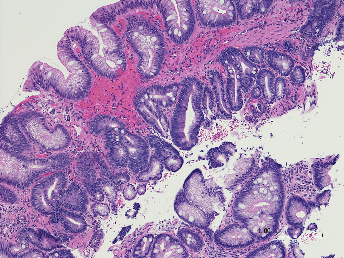 Σύνδρομο Barrett