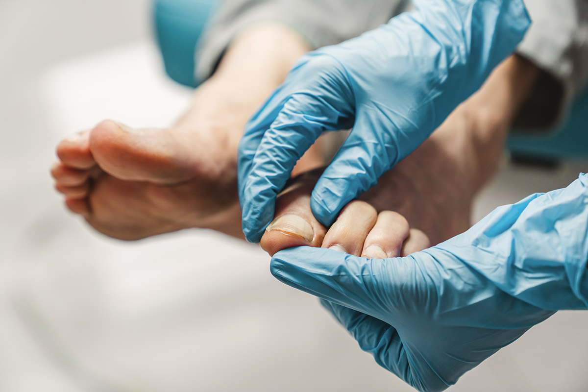 Πώς θα αποφύγεις τους μύκητες στα νύχια το καλοκαίρι 