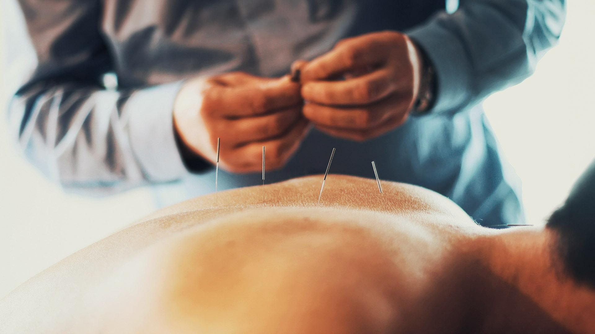 βελονισμός