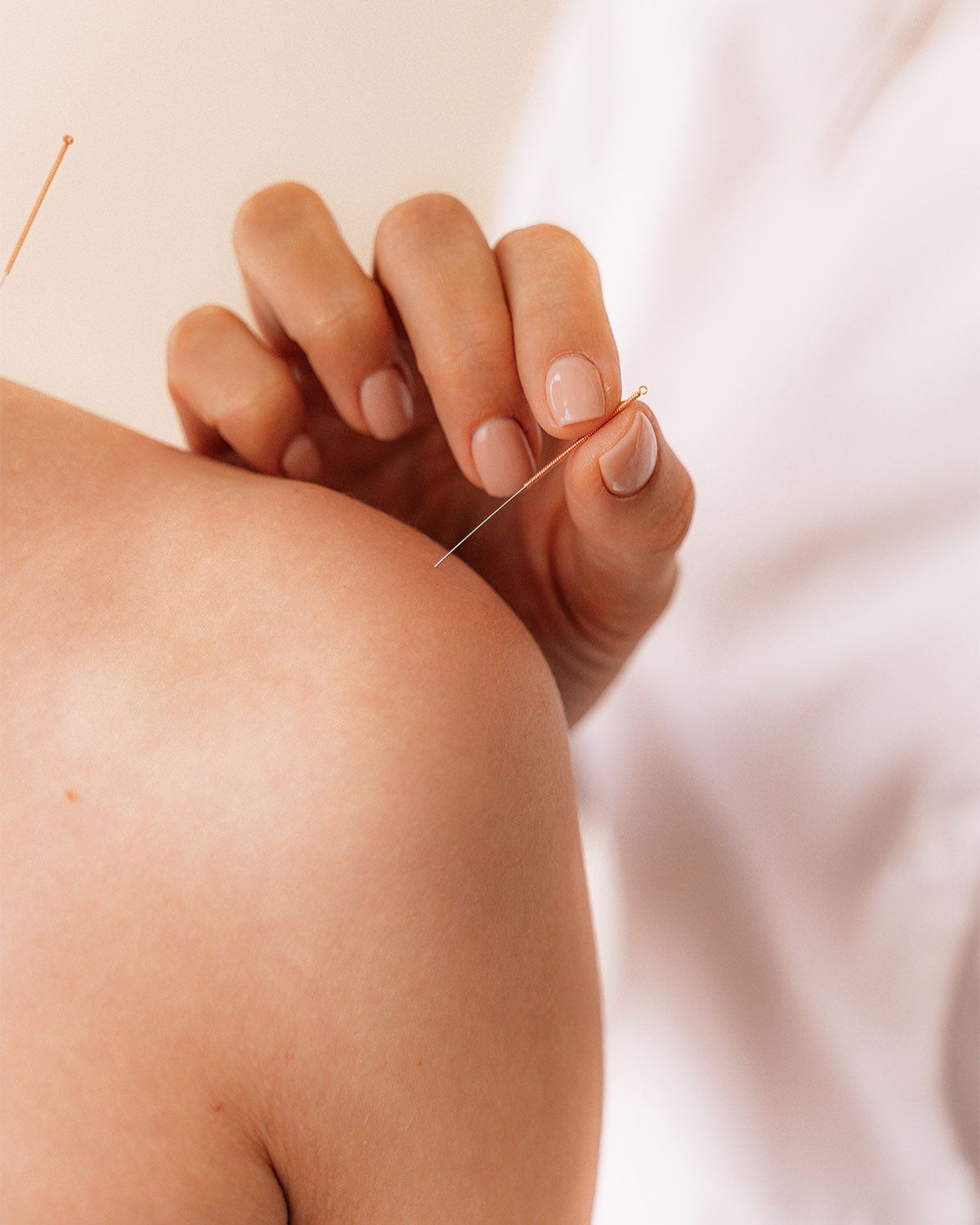 βελονισμός