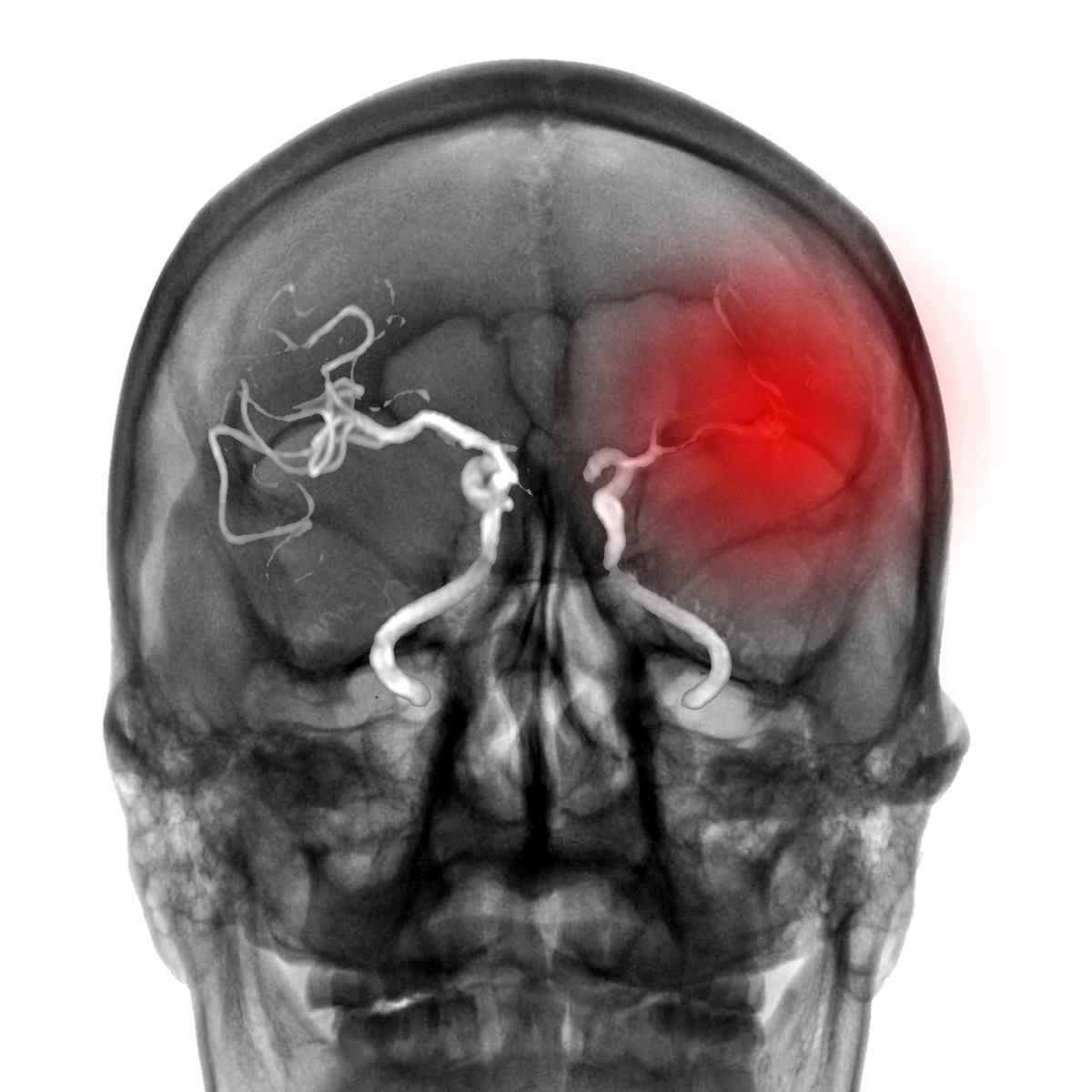 εγκεφαλικό