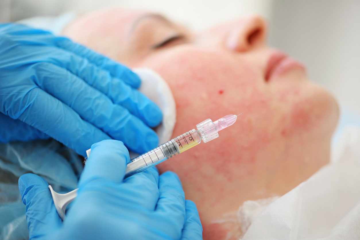 αυτόλογη μεσοθεραπεία