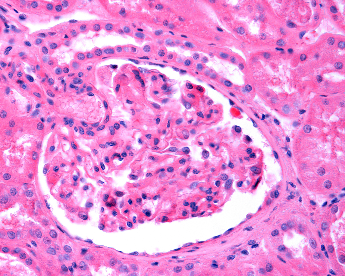 Διεισδυτικός στρεπτόκοκκος