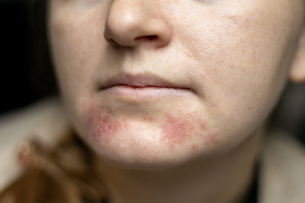 περιστοματική δερματοπάθεια