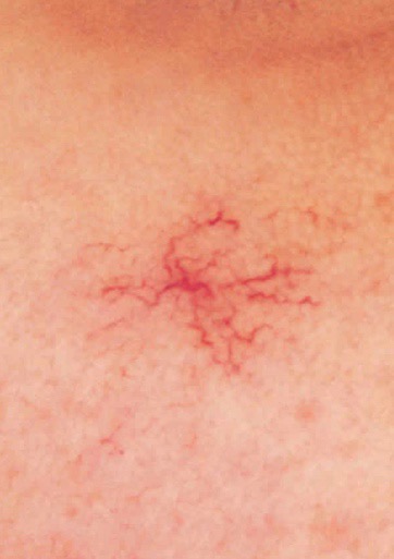 5 τρόποι που το δέρμα μας αποκαλύπτει κάποιο πρόβλημα υγείας