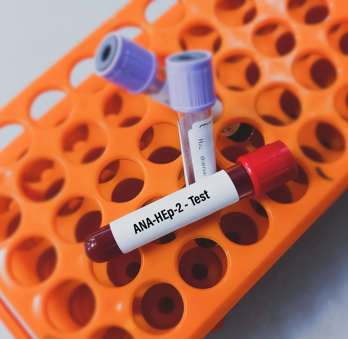 Υπάρχει εξέταση που απαντά στο αν έχεις αυτοάνοσο;