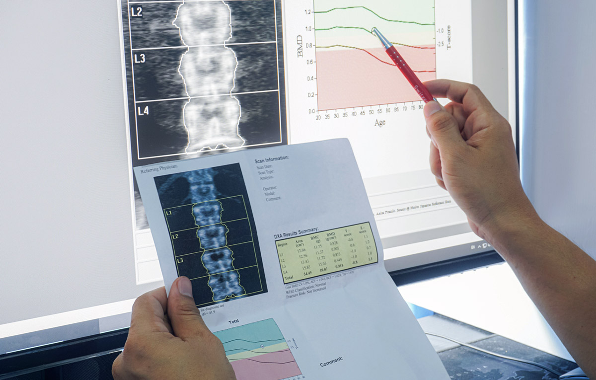 H τροφή που δεν ήξερες ότι βάζει φρένο στην οστεοπόρωση