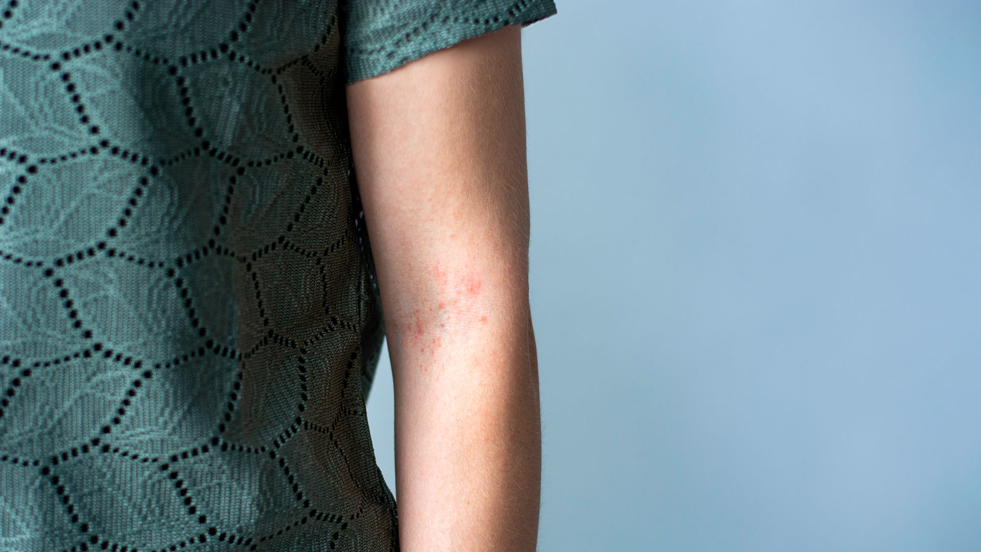 Πώς θα καταλάβεις αν έχεις αλλεργία στον ήλιο