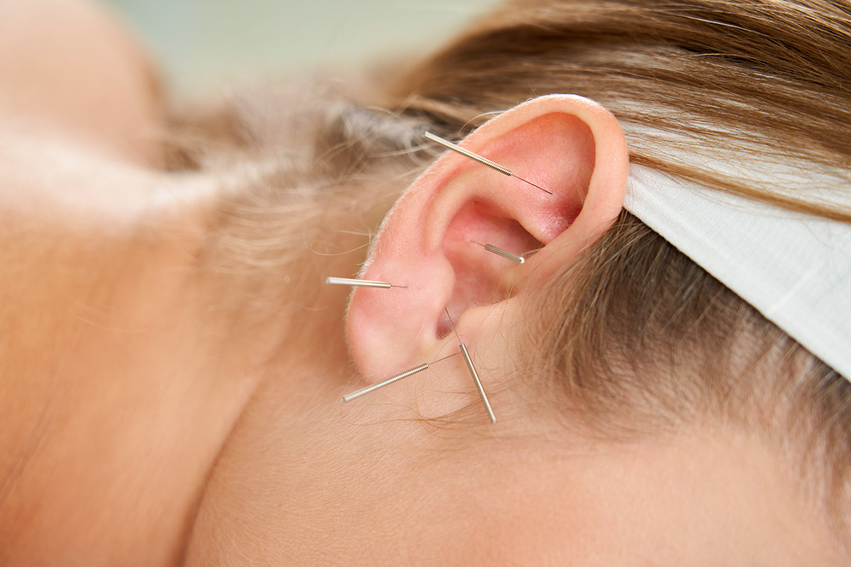 βελονισμός