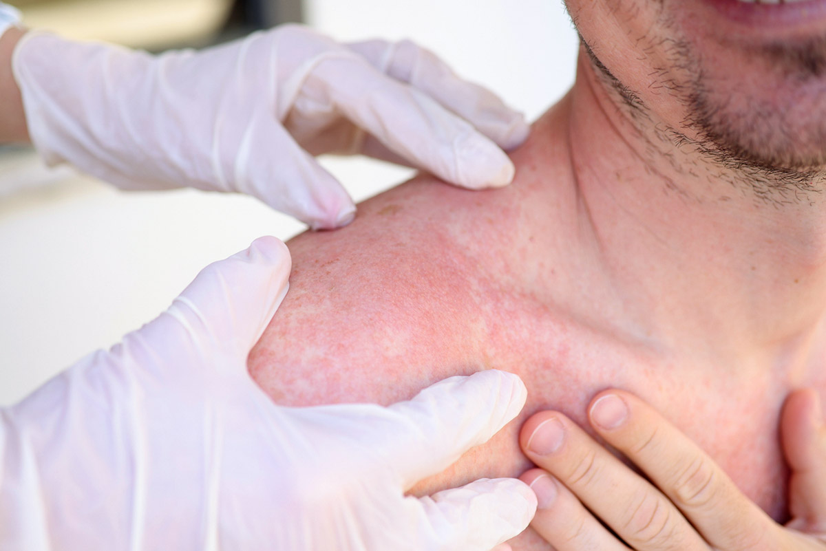 Ηλιακό έγκαυμα