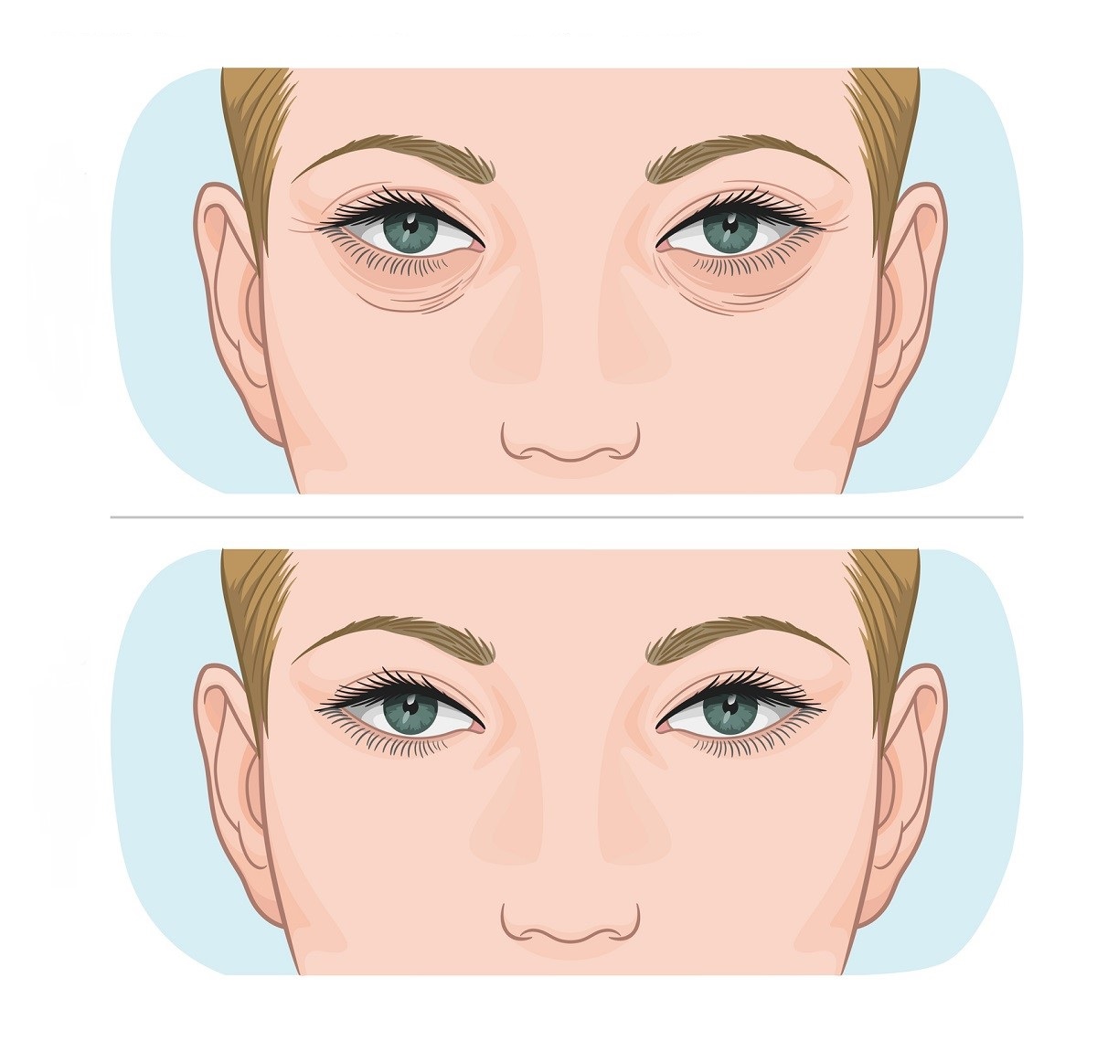 βλεβαροπλαστική