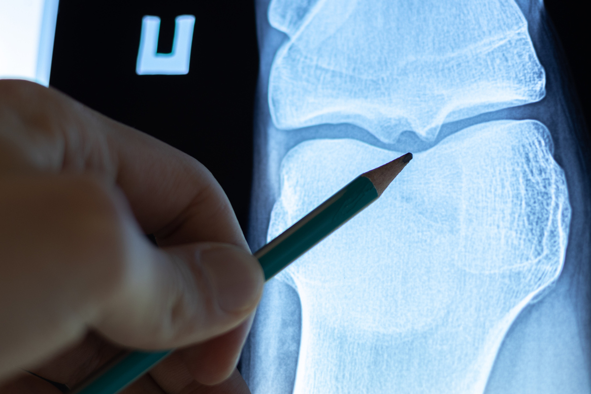 Το πιο κοινό φάρμακο για τον θυρεοειδή συνδέθηκε με την οστική απώλεια