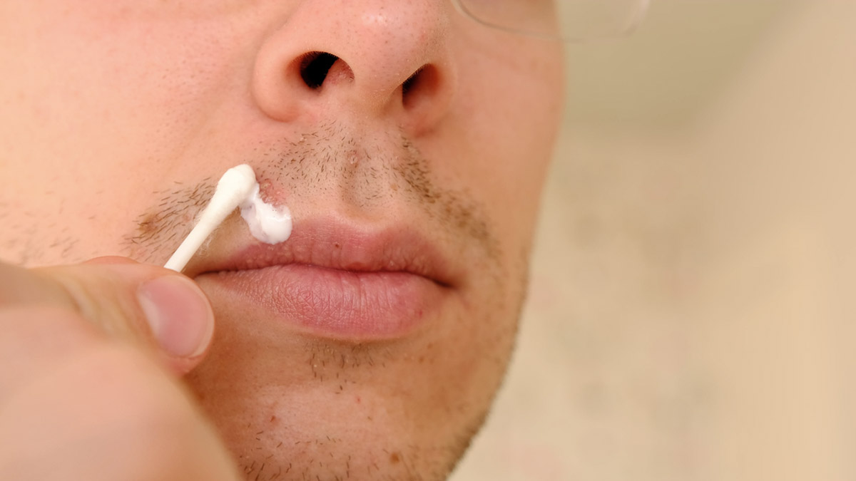 Έρπης στα χείλη: Ο αρχαιότερος ιός ίσως φτάνει στο τέλος του