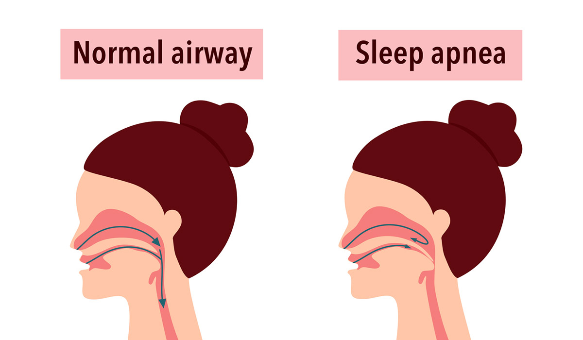 Τι μπορείς να κάνεις αν ο/η σύντροφός σου ροχαλίζει