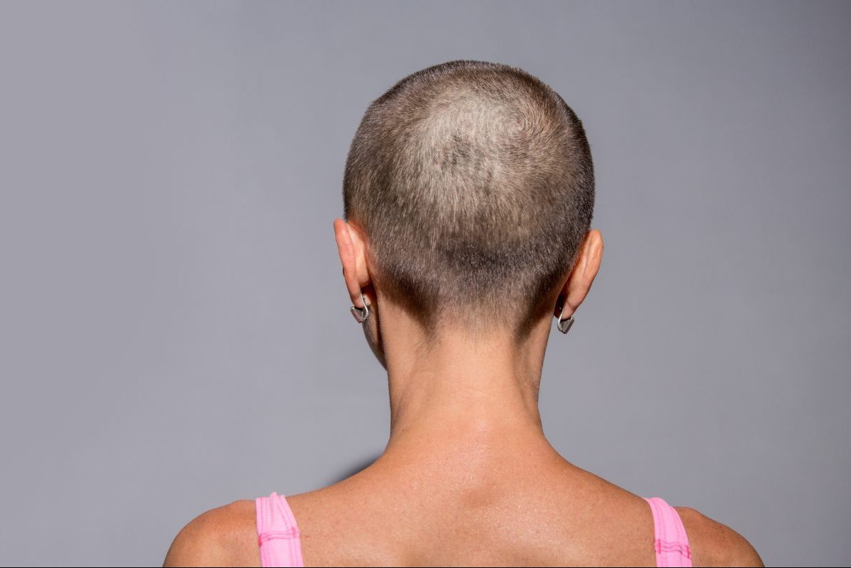 Γιατί αλλάζουν τα μαλλιά μετά τη χημειοθεραπεία