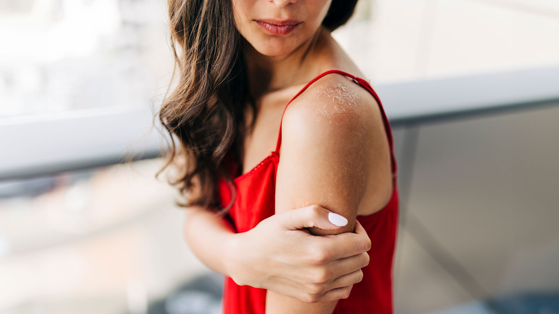 Ηλιακό έγκαυμα