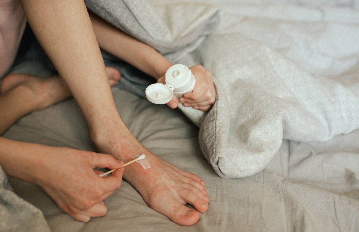 ατοπική δερματίτιδα