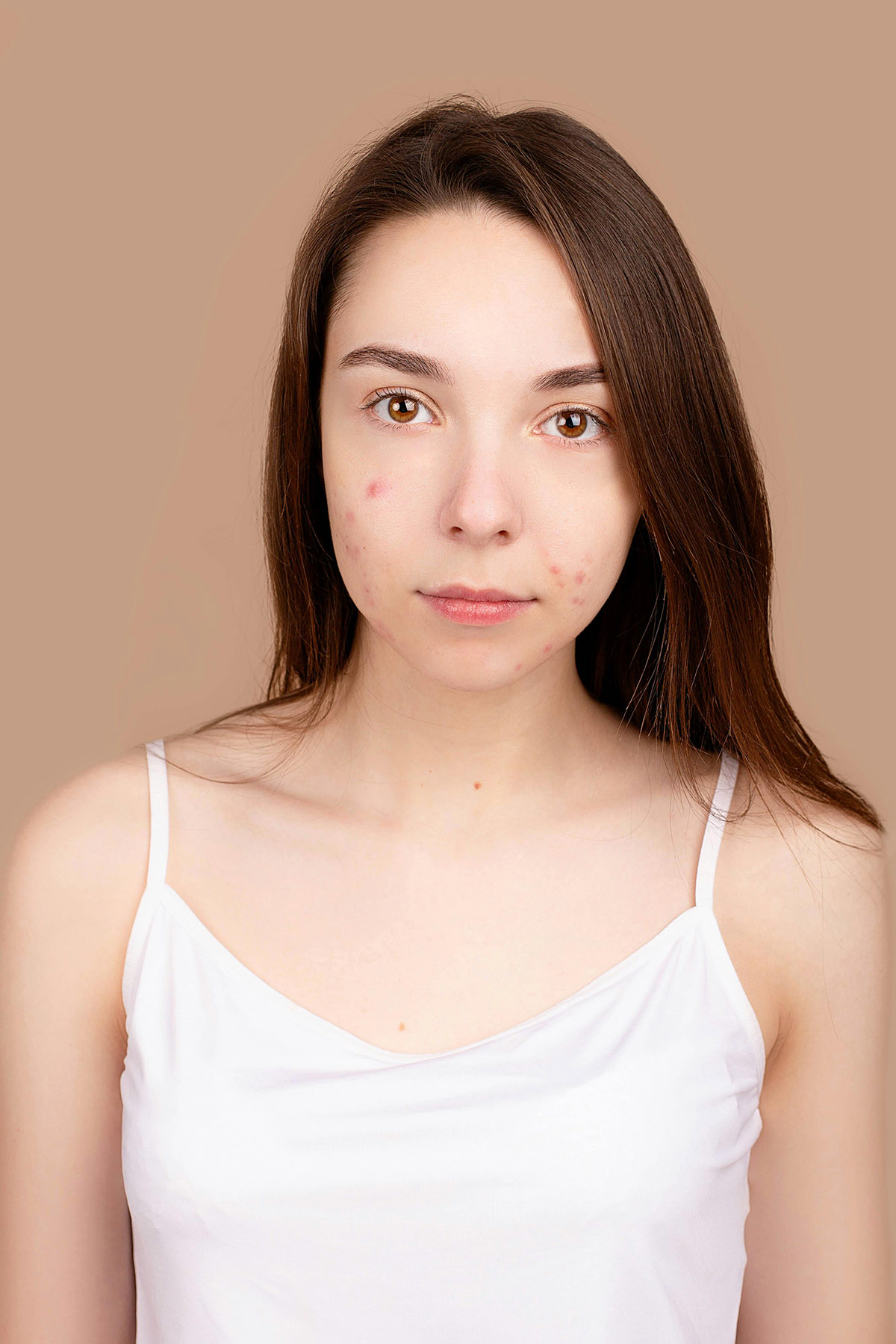 Φταίνε τα λιπαρά τρόφιμα για τα σπυράκια σου;