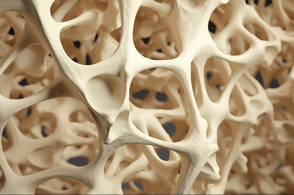 οστεοπόρωση