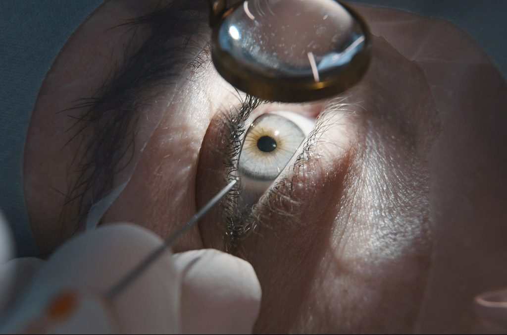 καταρράκτης ματιών