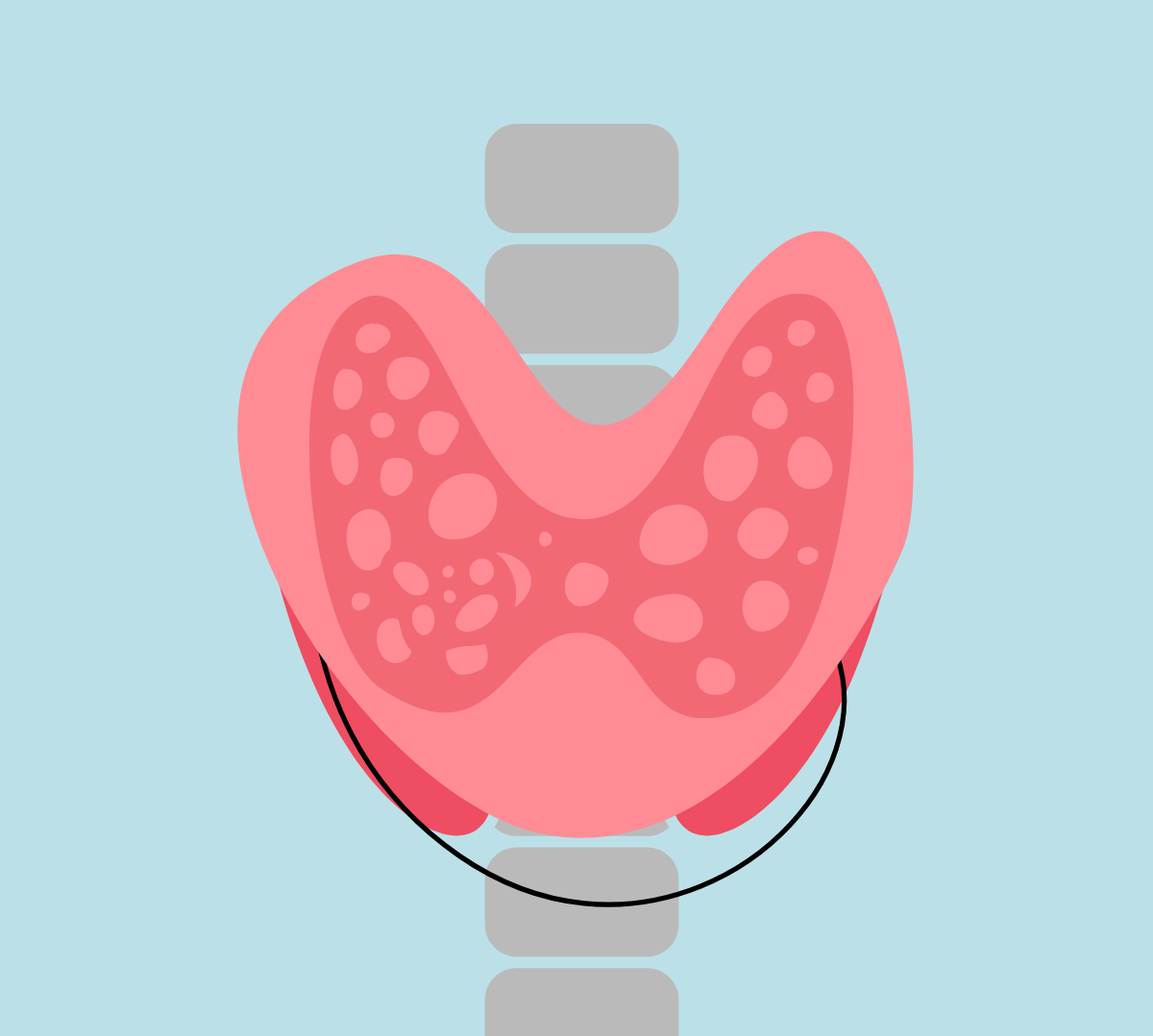 Η ζωή με τη νόσο Graves: Μια προσωπική μαρτυρία