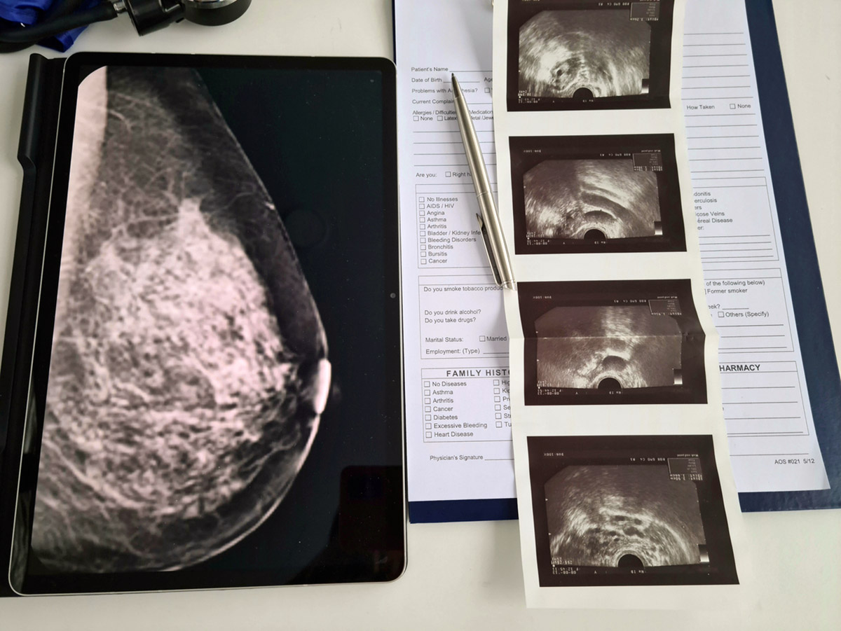 Σε ποια ηλικία σταματούν για τη γυναίκα οι μαστογραφίες;