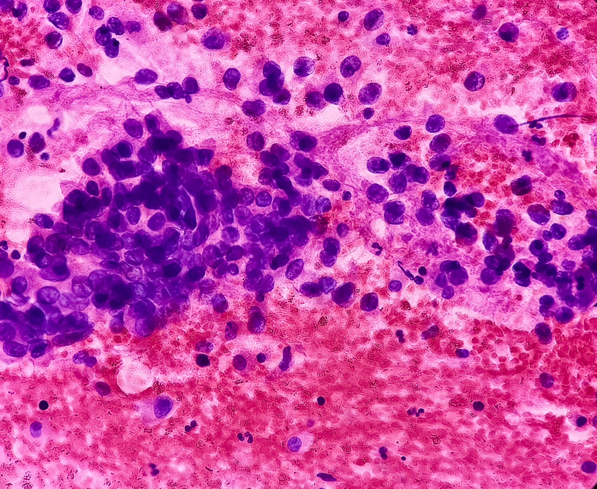 Έρχεται προληπτικό εμβόλιο για τον καρκίνο του πνεύμονα;