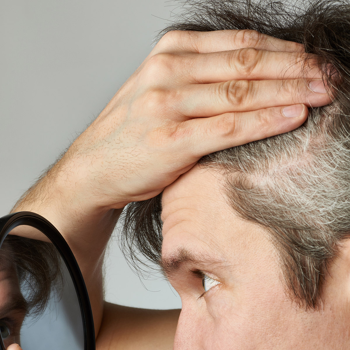 Ισχύει πως αν ξεριζώσεις μια λευκή τρίχα θα φυτρώσουν δύο στη θέση της;