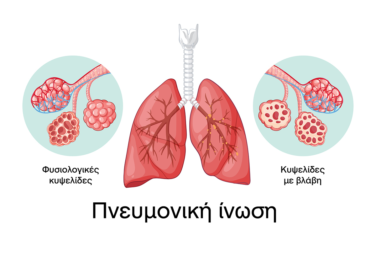 Τι είναι η πνευμονική ίνωση από την οποία έπασχε η βασίλισσα της Νορβηγίας;